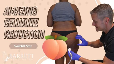 How To Get Rid Of Your Cellulite | Barrett Plastic Surgery