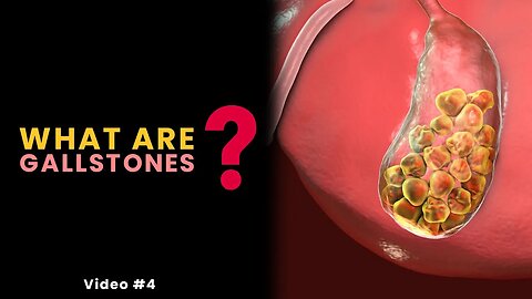 What Gallstones Are and How They Form? || Video #4