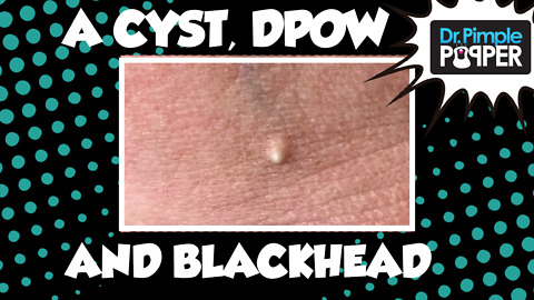 A Cyst, A Blackhead, & a Dilated Pore of Winer!!