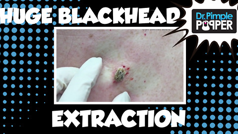 A huge blackhead extracted on the back!