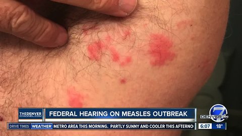 Rep. DeGette leads hearing on measles outbreak and vaccinations