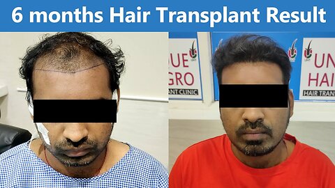 6 Month Hair Transplant Result