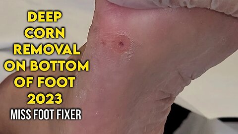 Treatment of Deep Foot Corn 2023 | Corn Removal on Bottom of Foot By podiatrist Miss Foot Fixer