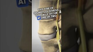 What is Spondylolisthesis ? #spondylolisthesis #sciatica #backpain #l4l5 #discbulges #backinjury