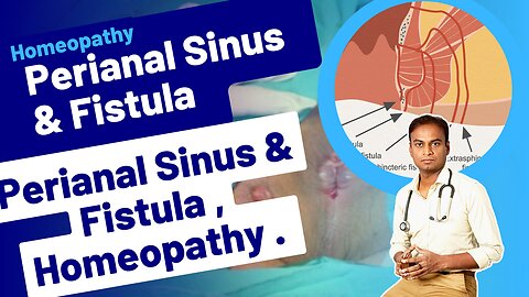 Perianal Sinus, Fistula and Homeopathy Treatment . | Dr. Bharadwaz | Homeopathy, Medicine & Surgery