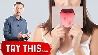 Burning Mouth Syndrome Demystified