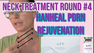 Neck Rejuvenation - Hanheal PDRN - AceCosm CODE ( Holly10 ) SAVE MONEY