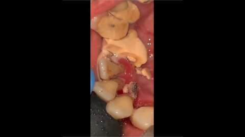 Removing Tartar from Teeth