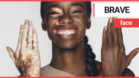 Model with vitiligo becomes the face of a New York billboard