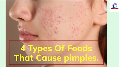 4 Types of foods that cause pimples