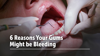 6 Reasons Your Gums Might be Bleeding