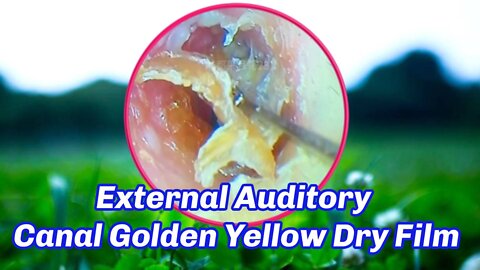 External Auditory Canal Golden Yellow Dry Film