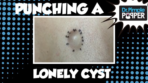 Dr Pimple Popper: Punching a Lonely Cyst!