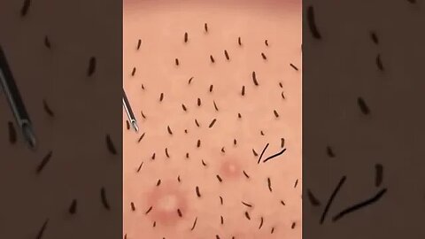 ASMR Ingrown Hair Removal Satisfying Skincare Animation #short