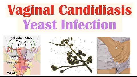 Vaginal Candidiasis (“Yeast Infection”) Causes, Risk Factors, Signs & Symptoms, Diagnosis, Treatment