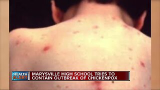 Marysville High School tries to contain outbreak of chickenpox