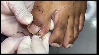 grandes unhas encravadas | large ingrown toenails #nails #toenails #podologia #podiatrist