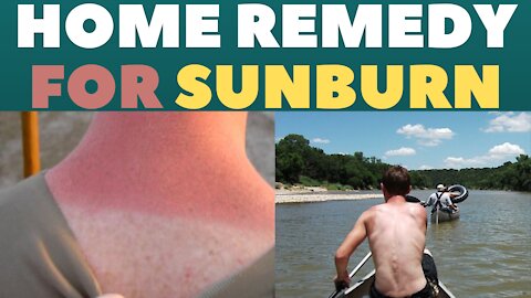 Natural And Simple Home Remedies For Sunburn (Tested Solutions).