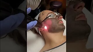 PicoSure Charcoal Laser Facial