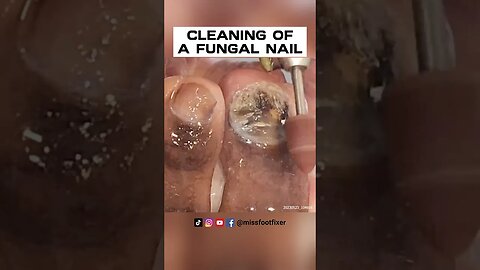 QUICK TREATMENT : CLEANING OF A FUNGAL NAIL IIN 7 MINUTES BY FOOT SPECIALIST MISS FOOT FIXER