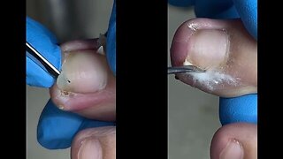 Satisfying Toenail ingrown removal #1