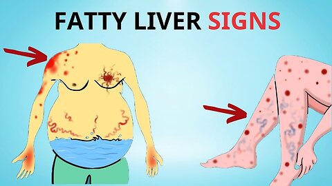 A Silent Threat: 8 Signs That Could Indicate Fatty Liver Disease | Healthy Care