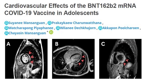 New prospective study shows cardiac abnormalities in 18% of adolescent vaxx recipients