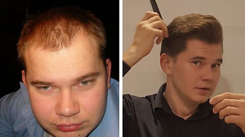 Why I Didn't Consider Hair Transplant But Instead Regrew My Hair