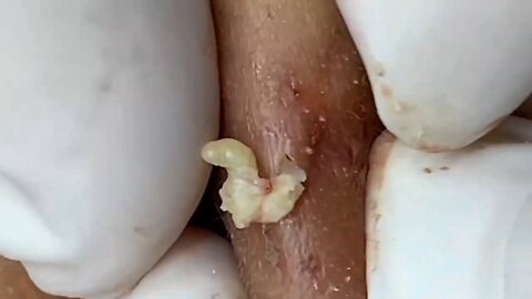 RELAX WITH THE BEST PIMPLE POPPING VIDEO #1