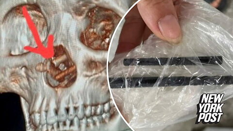 Man who suffered headaches for 5 months learns he had chopsticks stuck in his brain