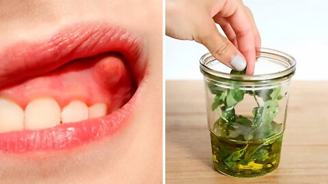 Heal Your Tooth Abscess / Dental Infection Naturally