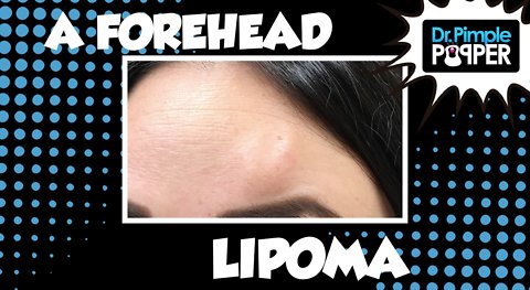 A Forehead Lipoma