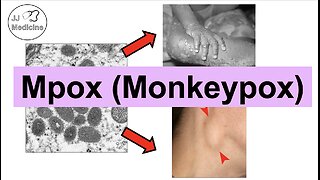 Mpox (Monkeypox) | Transmission, Pathophysiology, Signs & Symptoms, Diagnosis, Treatment