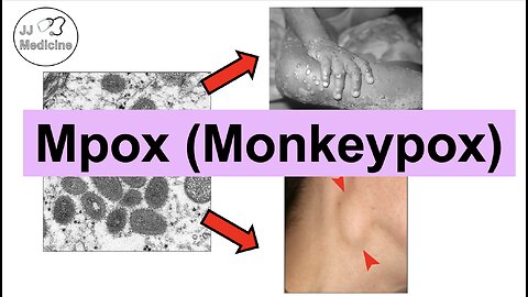 Mpox (Monkeypox) | Transmission, Pathophysiology, Signs & Symptoms, Diagnosis, Treatment