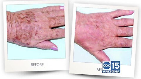 Martha Bartleson of Turn Back Time Spa & Wellness Clinic uses intense pulse light to remove dark spots and reduce lines and wrinkles