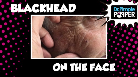 When Blackheads Clam Up!