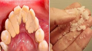 How to Get Rid of Plaque - Home Remedies for Plaque and Tartar