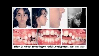 Effect of Mouth Breathing on Facial Development by Dr Mike Mew