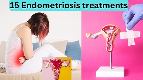15 Endometriosis treatments