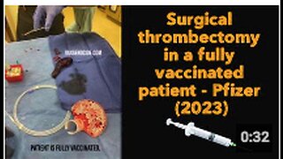 Surgical thrombectomy in a fully vaccinated patient - Pfizer (2023)