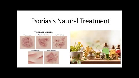 Psoriasis Natural Treatment