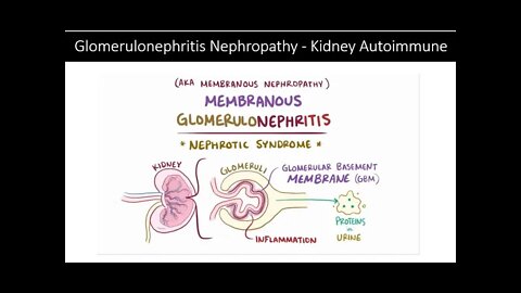 Kidney Autoimmune Glomerulonephritis Nephropathy