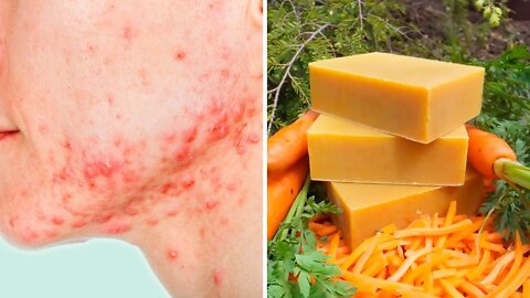 SABONETE DE CENOURA FAÇA VOCÊ MESMO PARA CURAR ACNE, TRATAR ESPINHAS E MUITO MAIS