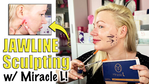 Jawline Sculpting with Miracle L (Liquid PCL) from Acecosm.com | Code Jessica10 Saves you Money!