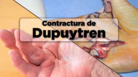 Cosas que deberías de saber sobre la contractura de Dupuytren