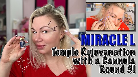 Temple Rejuvination with Miracle L via Cannula! AceCosm, Code Jessica10 saves you money