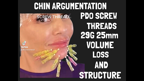 Chin Augmentation with Pdo Boost Collagen