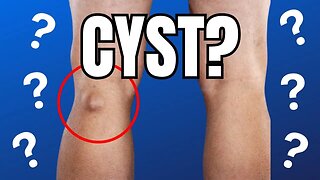 Bump On Back Of Knee? (Baker's Cyst, Popliteal Cyst)