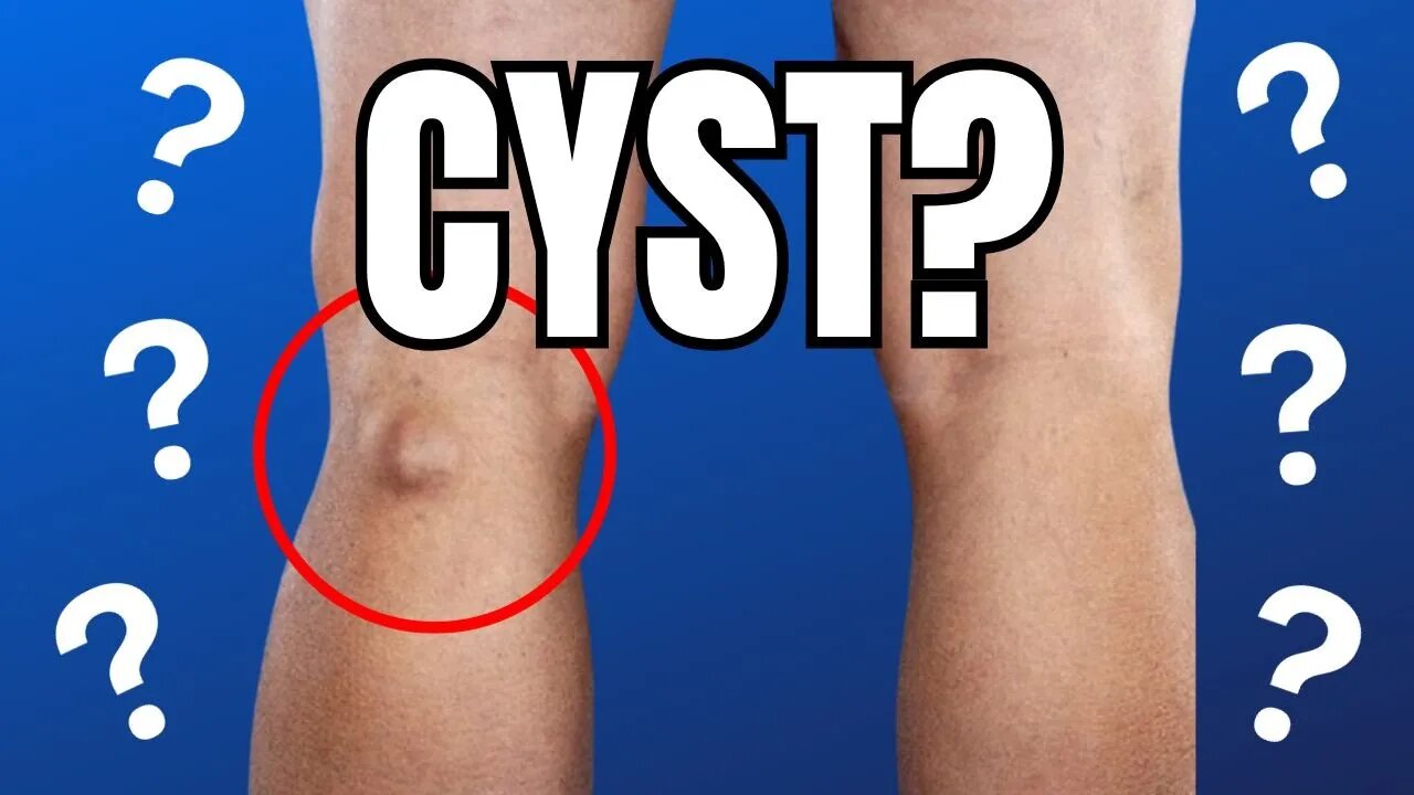 Bump On Back Of Knee Baker S Cyst Popliteal Cyst