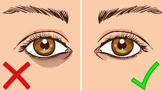 How To Get Rid Of Dark Circles Under Your Eyes